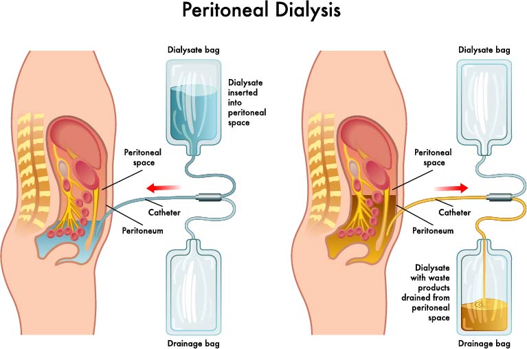 Dialysis Treatment