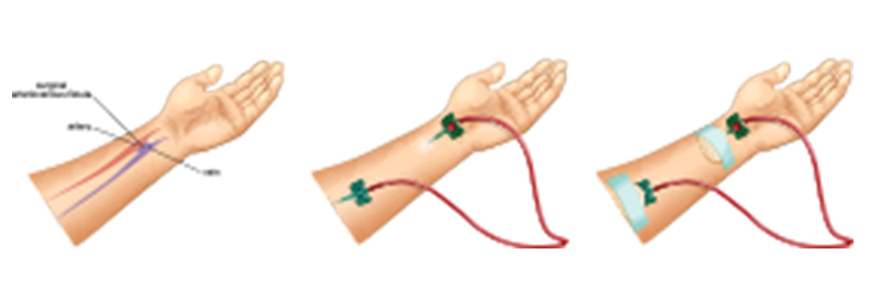 AV Fistula Hemodialysis